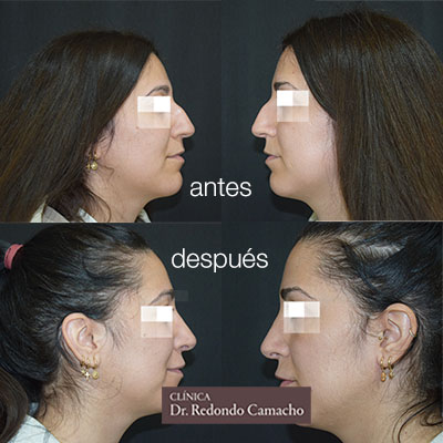 antes y despues rinoseptoplastia