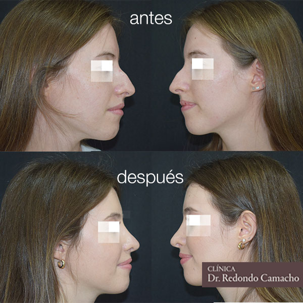 rinoplastia antes y despues | dr redondo caso 2