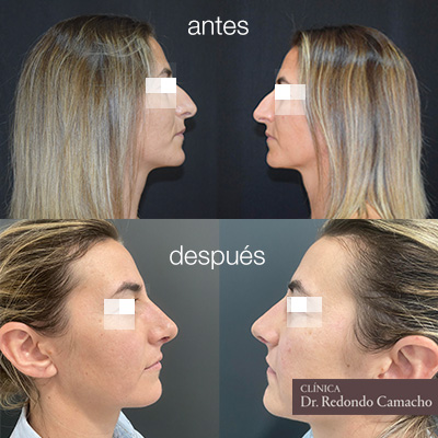 rinoplastia antes y después | redondo estetica, Córdoba