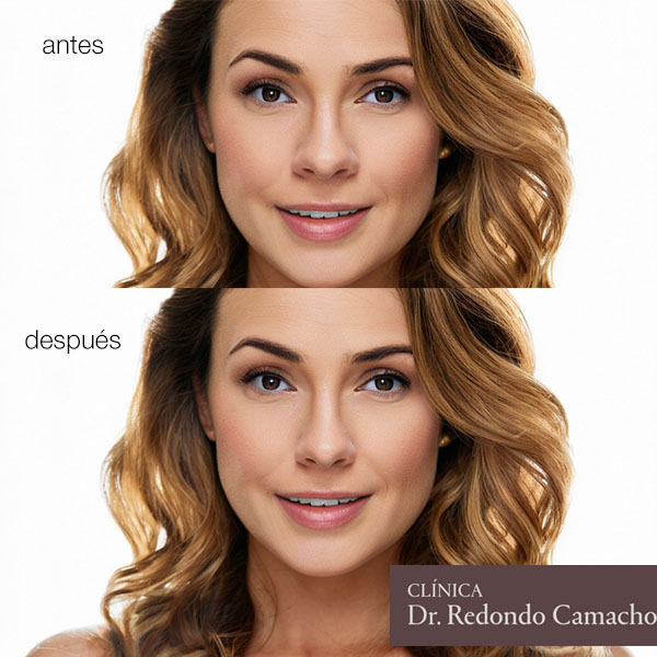 rinoplastia de reduccion de aletas nasales