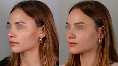 rinoseptoplastia | testimonio 2