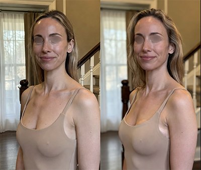 mastopexia antes y despues | testimonio 4