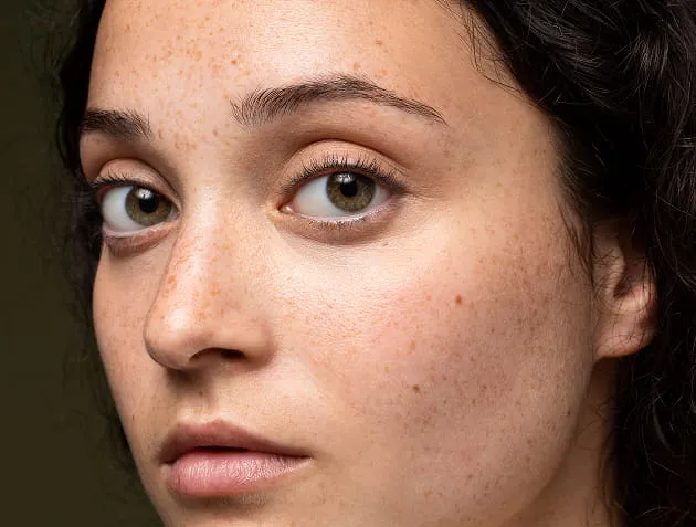 14_medicina-estetica-manchas1